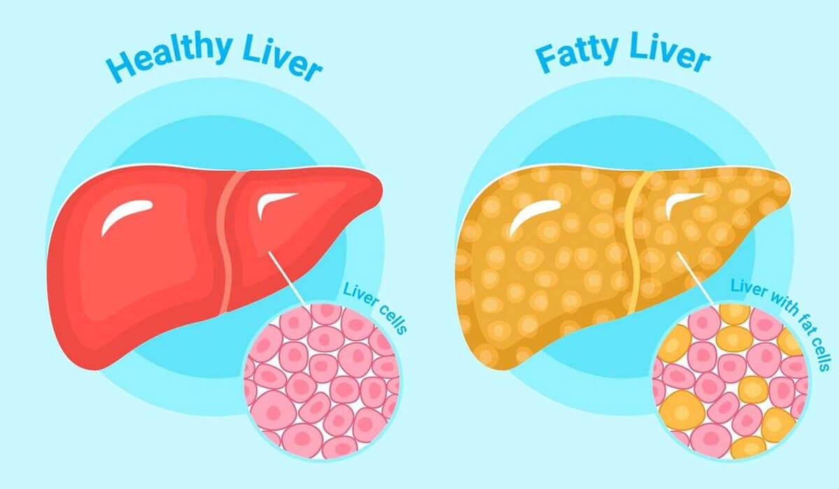 How Fatty Liver Is Harmful for the Body: Understanding Its Silent Threat